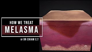 My 4Step Approach to Treating Melasma  Dr Chiam Chiak Teng [upl. by Germaun]