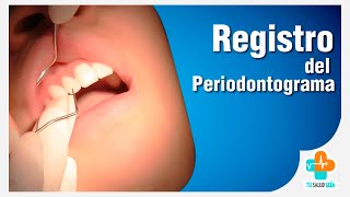 Registro del Periodontograma  Tu Salud Guía [upl. by Jeth88]