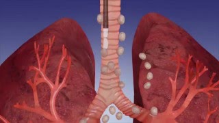 EBUS Procedure OverviewOlympus Bronchoscopy [upl. by Getraer180]