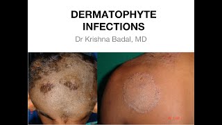 Dermatophyte infections of Skin [upl. by Adnaluy]