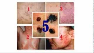 Serious Skin Disorders – More Than Skin Deep [upl. by Llertnek]