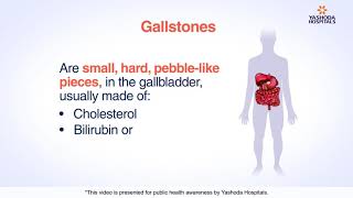 Why Do Gall Stones Form  Gall Stones Formation Explained  SCI Hospital [upl. by Rolo]