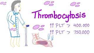 Thrombocytosis Primary and Secondary  Why Is My Platelet Count High  Hematology [upl. by Domineca227]