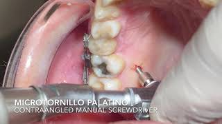 Palatal Miniscrew Placement Inserción Microtornillo Palatino [upl. by Elsbeth690]