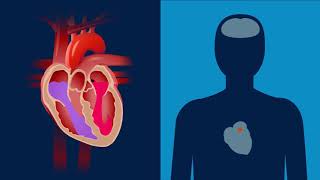 Was ist Vorhofflimmern  Erklärfilm  Medtronic [upl. by Krever]