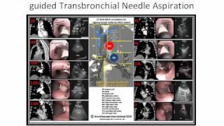 EBUSCTBronchoscopy Poster [upl. by Krueger391]