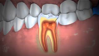 Treatment of Abscessed Teeth [upl. by Brom973]