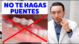 NO TE HAGAS PUENTES DENTALES FIJOS sin evaluar primero opciones más conservadoras [upl. by Akehsar]