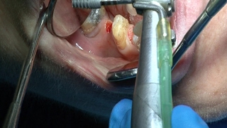 Implantes endodoncia coronas  Odontologia Multidisciplinar Dentistry Multidisciplinary [upl. by Bickart]