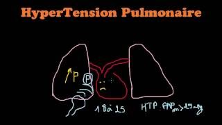 SmartNEasy Cardio  HyperTension Pulmonaire  Dr Astuce [upl. by Alidis]