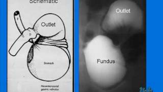 Gastric Volvulus in a Newborn [upl. by Alioz]