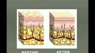 Fat reduction with Injection Lipolysis  Lipodissolve [upl. by Adaliah]