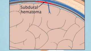 Understanding Subdural Hematoma [upl. by Ais]