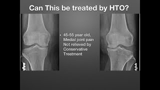 Knee Replacement Recovery Timeline After Surgery [upl. by Ossy]