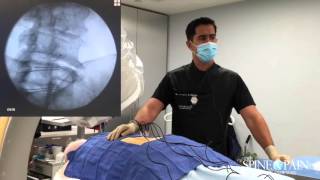 Radiofrequency Ablation Procedure [upl. by Mellitz]