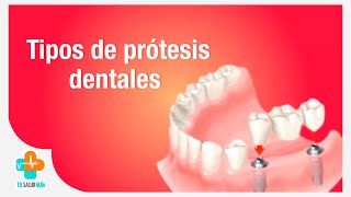 Tipos de prótesis dentales  Tu Salud Guía [upl. by Eenel21]