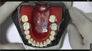 Biomecánica Ortodoncia  2das molares inferiore y superiores [upl. by Ranjiv]