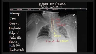 Radio du thorax  ABCDEFGHI  Partie 2  Docteur Synapse [upl. by Bekah]