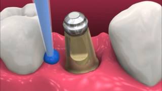 Smyl Manatee  Dental Implant Procedure [upl. by Acinahs]