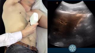 Gallstone Symptoms and Causes Explained – DrBerg on Gallbladder Stone Removal [upl. by Yrogerg532]