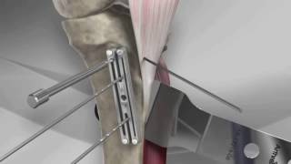 Tibial Tubercle Osteotomy [upl. by Swift]