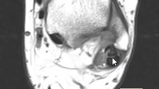 Longitudinal Split Tear Peroneus Brevis Tendon [upl. by Singband]