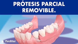 Prótesis parcial removible  ¿Cómo funcionan © [upl. by Aneles406]
