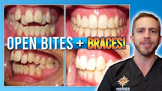 Open Bite Braces Treatment BEFORE amp AFTER [upl. by Lednahs]