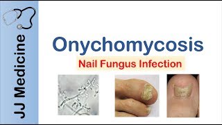 Onychomycosis  Nail Infection  Signs Symptoms Treatment [upl. by Ambrosane]