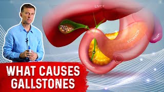 What Really Causes Gallstones  Dr Berg [upl. by Artnoed934]