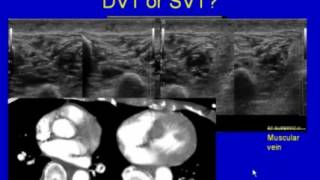 Ultrasound Scanning for Deep Venous Thrombosis [upl. by Milstone]