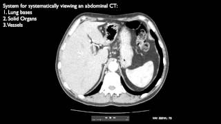 How to interpret an abdominal CT [upl. by Chobot]