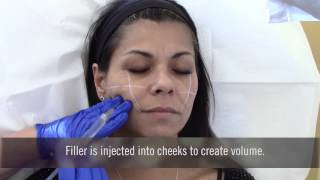 Injecting fillers in cheeks at Advanced Dermatology [upl. by Redle]