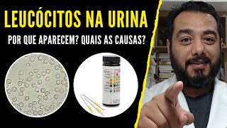 Leucócitos altos na urina o que significa  E com urocultura negativa ausência de bactérias [upl. by Landmeier]