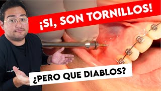 LE PONEN DOS MICRO TORNILLOS EN SU HUESO CASO REAL MINI IMPLANTES EN ORTODONCIA ¿CÒMO SE PONEN [upl. by Esinal228]