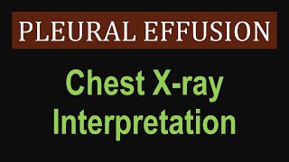 Pleural Effusion  Chest Xray Interpretation [upl. by Eanahc242]