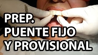 Preparaciones Puente Fijo y Provisional Anterior 👅Parte1 [upl. by Langsdon]