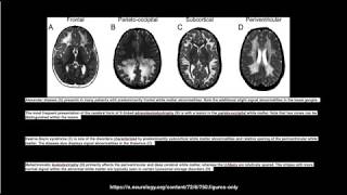 Myelination milestones Approach [upl. by Cowley]