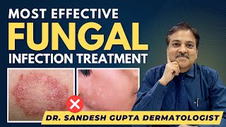 Effective Fungal Infection Treatment By Dermatologist  Dr SANDESH GUPTA 9990804089 [upl. by Arriat]