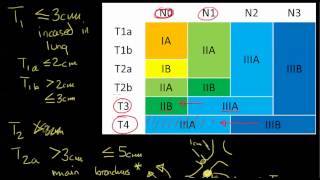 Breast Cancer Type and Stage What You Need to Know [upl. by Nore]