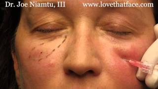 5 minute cheeks by Dr Joe Niamtu III [upl. by Formica915]