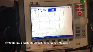 Supraventricular Tachycardia SVT Cardioversion with Adenosine intravenous [upl. by Gluck]