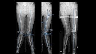 PostOperative Recovery from Knee Replacement Surgery [upl. by Jolyn223]