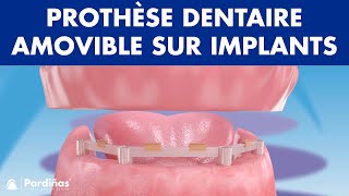 Prothèse dentaire amovible sur implants © [upl. by Yralih911]