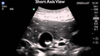 Ultrasound Video showing Cholelithiasis associated with Choledocholithiasis [upl. by Aerona]