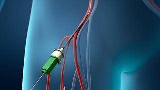 Coronary Angioplasty Femoral Access [upl. by Aynekat]