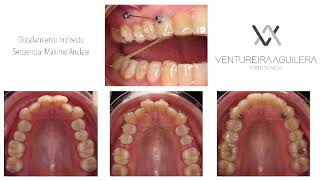 Distalamiento Secuencial Invisalign con Minitornillo Sequential Invisalign Distalization Miniscrew [upl. by Lenoyl]