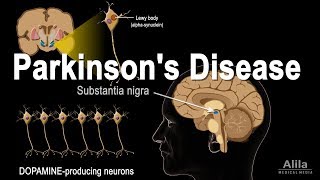 Understanding Parkinson’s Disease [upl. by Farland]