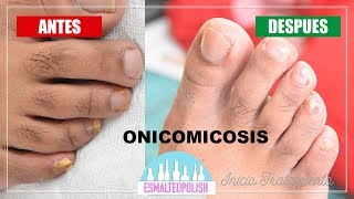 Onicomicosis Eliminar hongo de las uñas  Esmalteopolish [upl. by Savory]