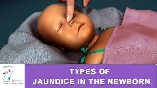 Jaundice Causes and Treatment  Dr Amit Sanghi Hindi [upl. by Davin343]